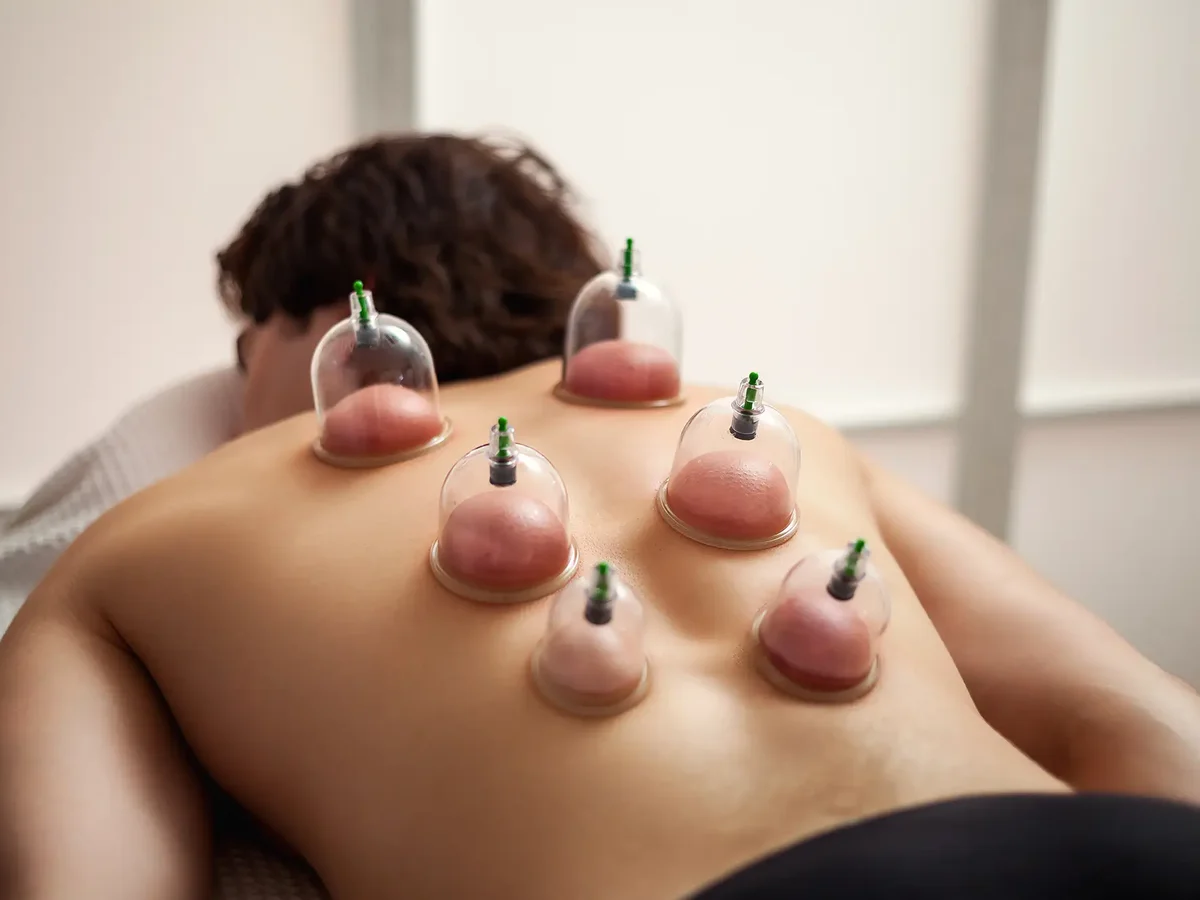 Clinician performing cupping therapy on a patient's back