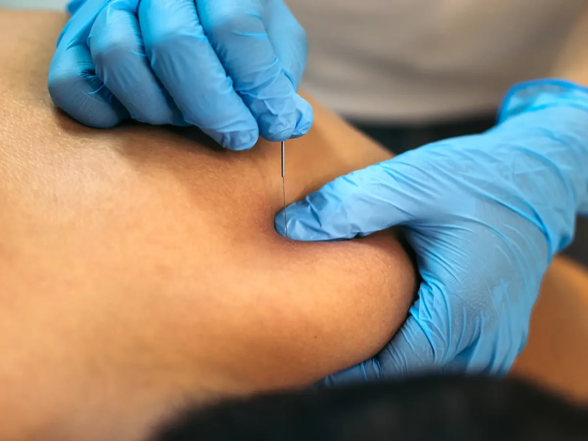 Clinician performing dry needling trigger-point treatment