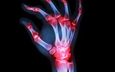 Do I Have Rheumatoid Arthritis Or Carpal Tunnel Disease? 5 Key Differences