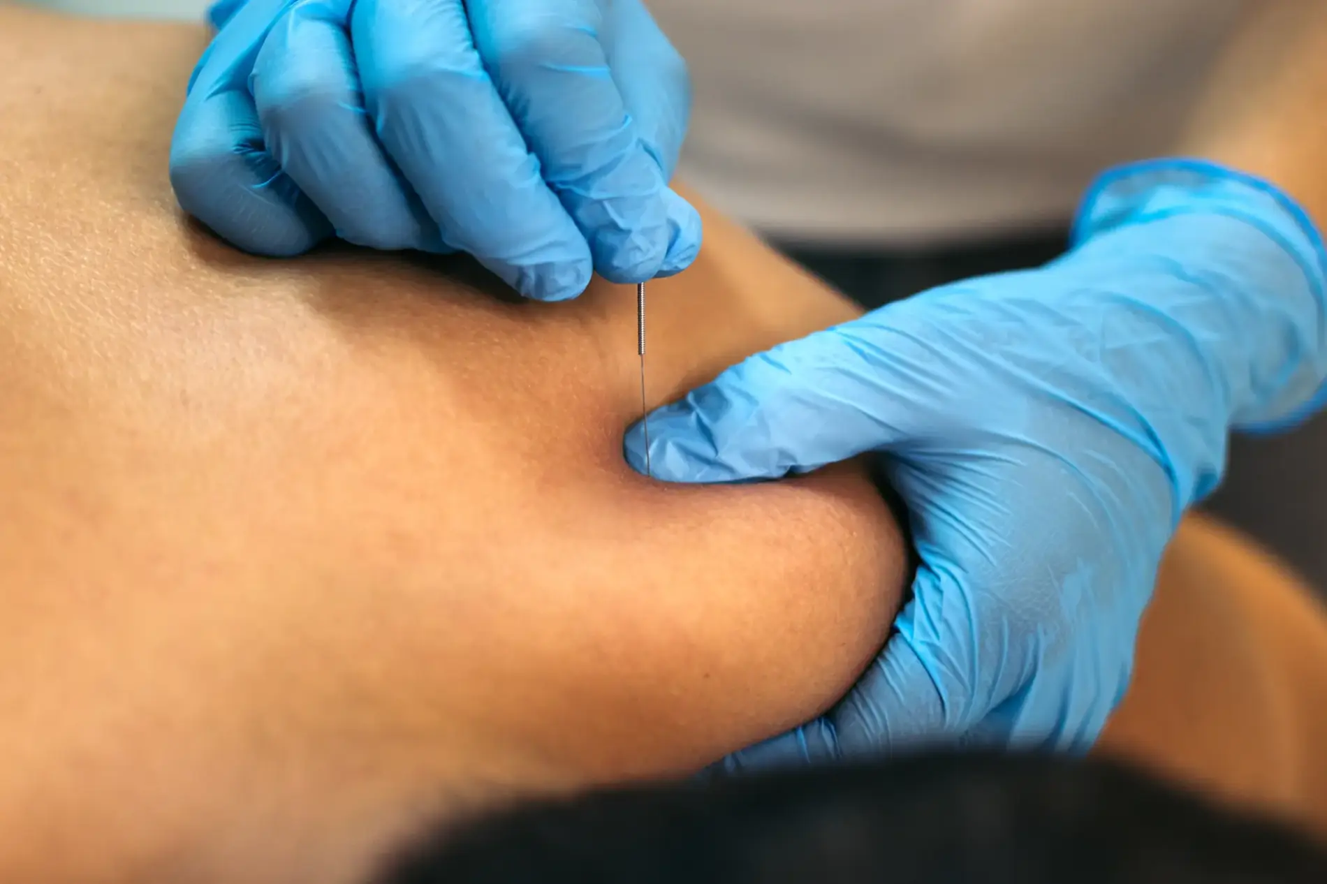 Dry Needling in Louisville